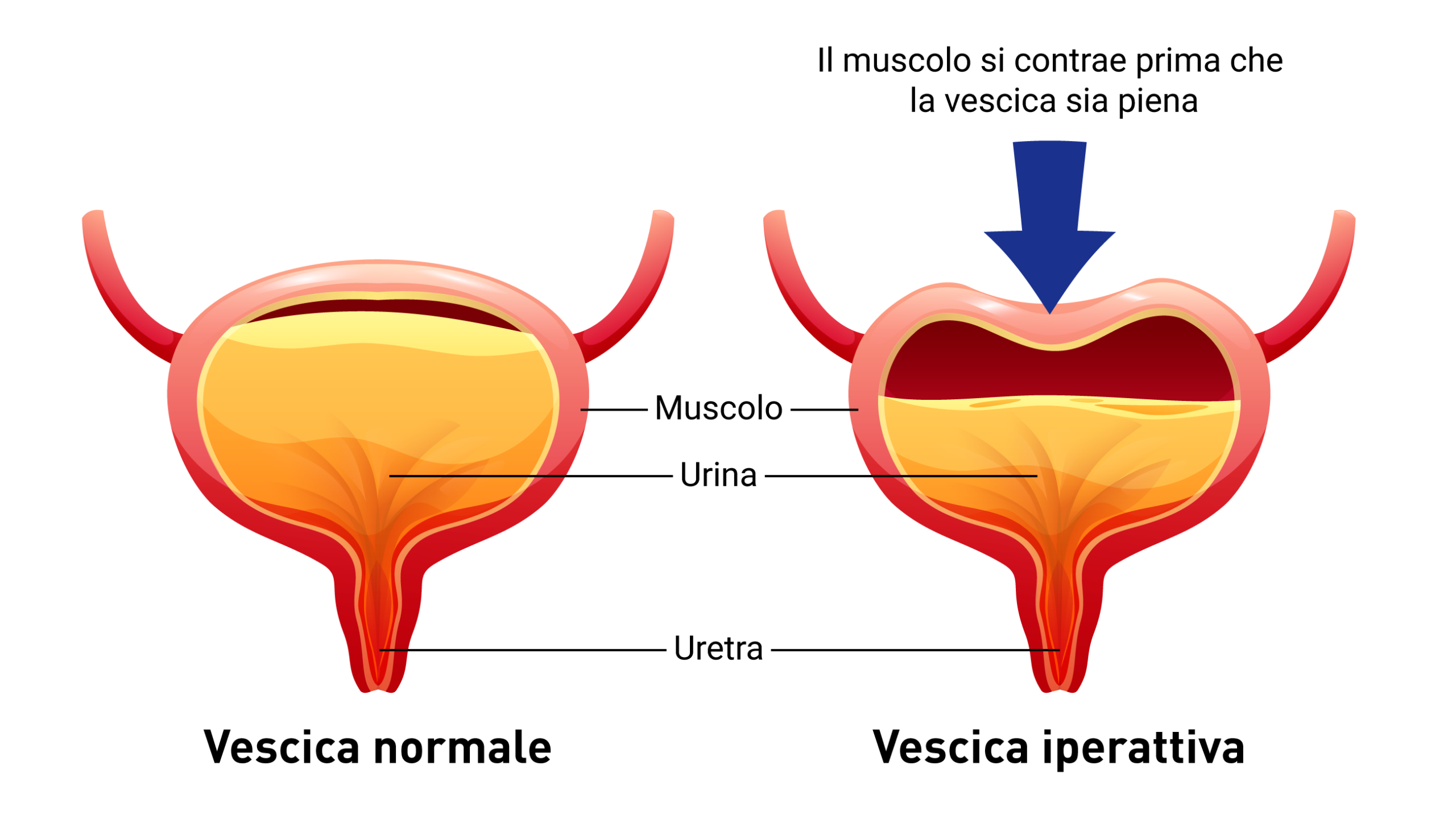 Grafico: vescica normale vs. vescica iperattiva