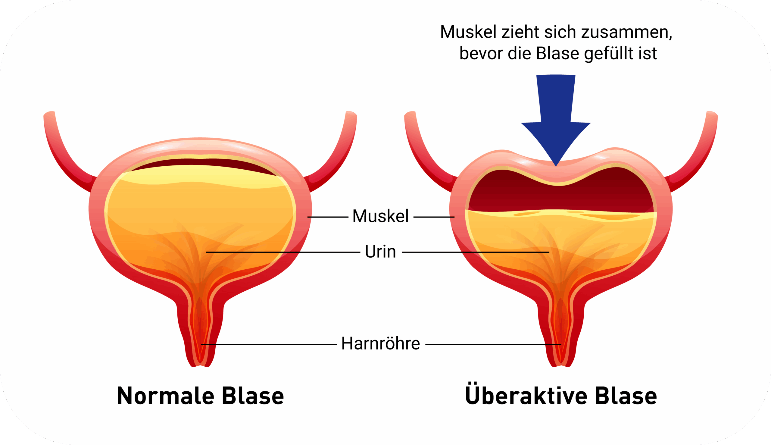 Schaubild Normale vs. Überaktive Blase